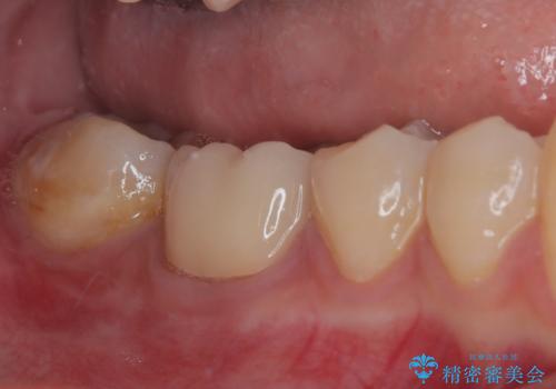 歯茎が腫れている 奥歯の根管治療の治療後