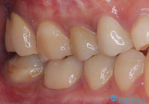 歯茎が腫れている 奥歯の根管治療の治療後