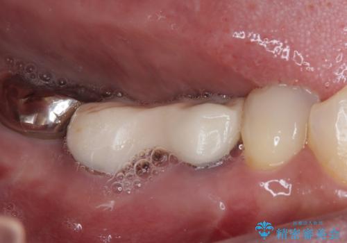 放置していたむし歯 抜歯即時埋入インプラントによる補綴治療の治療前