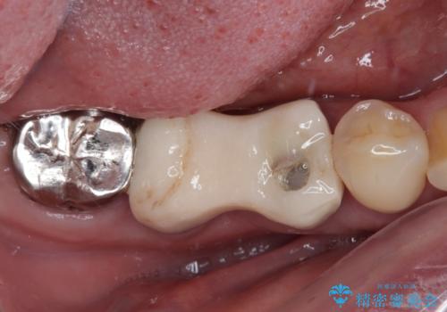 放置していたむし歯 抜歯即時埋入インプラントによる補綴治療の治療前