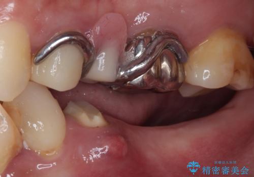 放置していたむし歯 抜歯即時埋入インプラントによる補綴治療の治療前