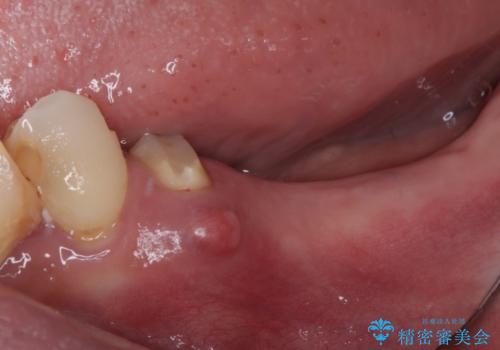 放置していたむし歯 抜歯即時埋入インプラントによる補綴治療の治療前