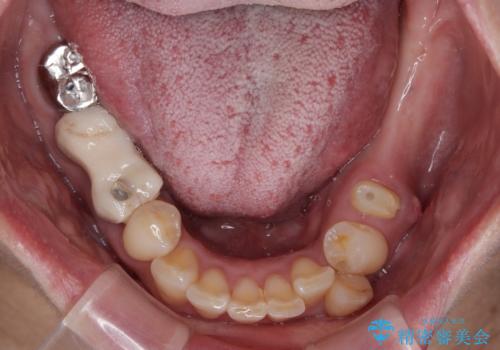 放置していたむし歯 抜歯即時埋入インプラントによる補綴治療の症例 治療前