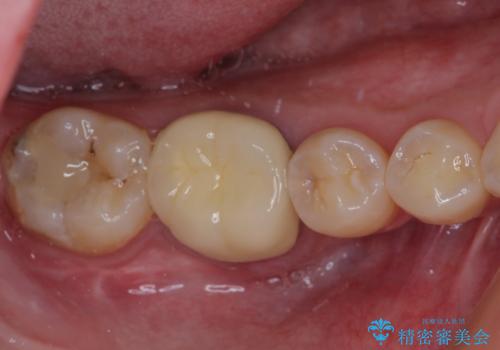 歯茎が腫れている 奥歯の根管治療の治療前