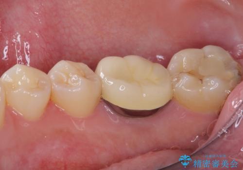 歯茎が腫れている 奥歯の根管治療の治療前