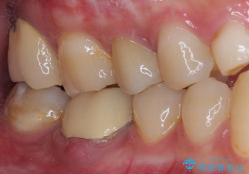歯茎が腫れている 奥歯の根管治療の治療前