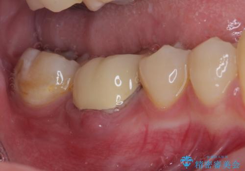 歯茎が腫れている 奥歯の根管治療の治療前