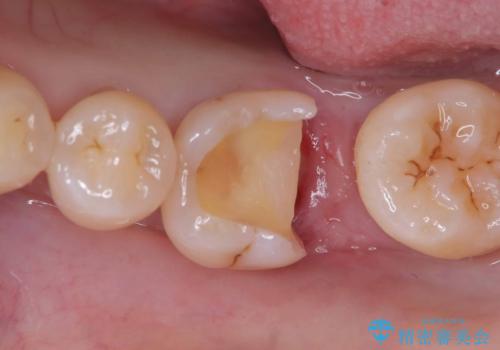 銀歯の下の虫歯|生活歯髄療法|VPT|神経を残すための治療|セラッミクインレーの治療中