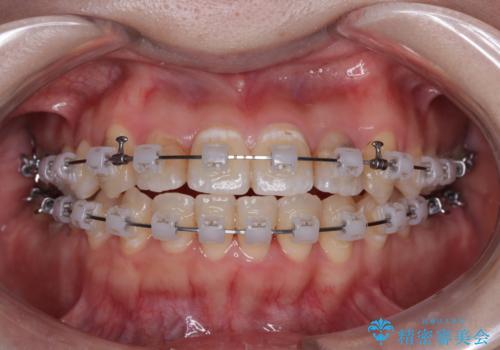 むし歯と八重歯を治したい 総合歯科治療の治療中