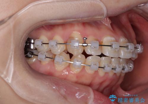 むし歯と八重歯を治したい 総合歯科治療の治療中