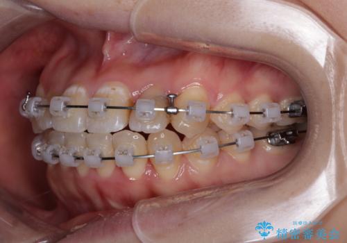 むし歯と八重歯を治したい 総合歯科治療の治療中