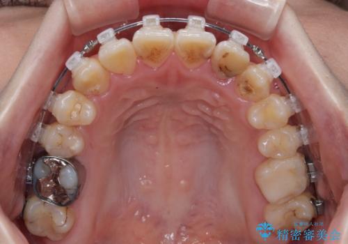 むし歯と八重歯を治したい 総合歯科治療の治療中