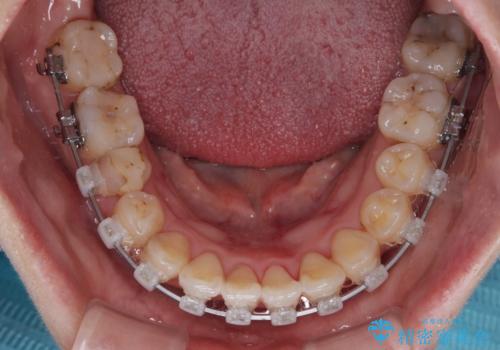 むし歯と八重歯を治したい 総合歯科治療の治療中