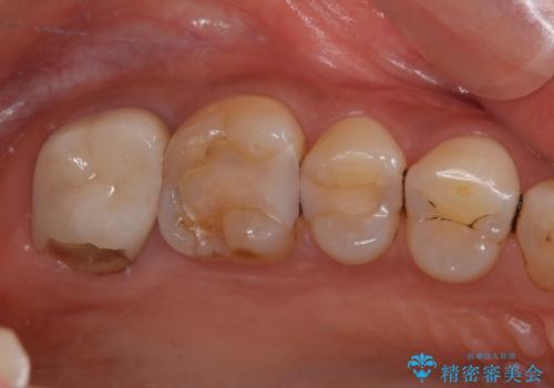 被せものが欠けた オールセラミッククラウンの症例 治療前