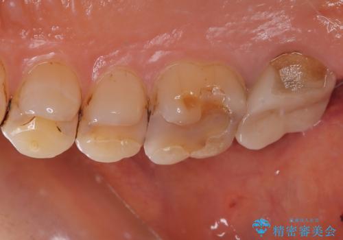 被せものが欠けた オールセラミッククラウンの治療前
