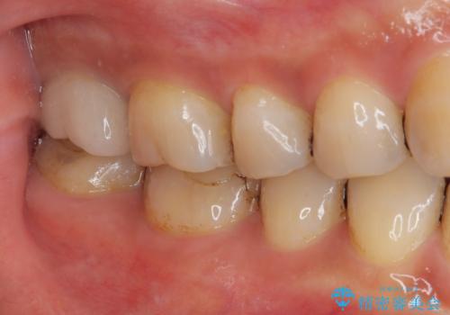 被せものが欠けた オールセラミッククラウンの治療前