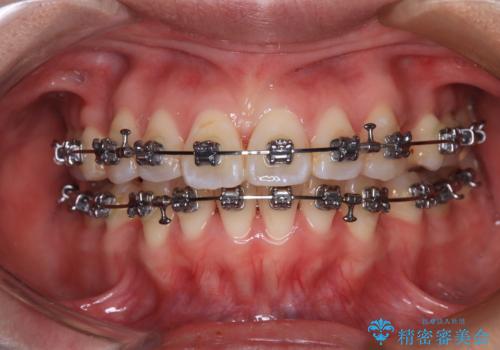 【モニター】口が閉じられない ワイヤー装置での抜歯矯正の治療中