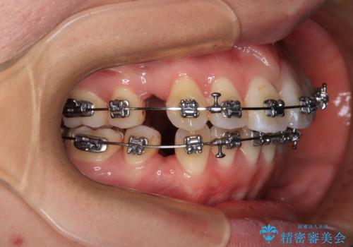 【モニター】口が閉じられない ワイヤー装置での抜歯矯正の治療中