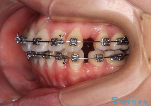 【モニター】口が閉じられない ワイヤー装置での抜歯矯正の治療中