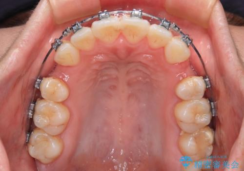 【モニター】口が閉じられない ワイヤー装置での抜歯矯正の治療中