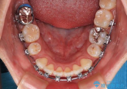 【モニター】口が閉じられない ワイヤー装置での抜歯矯正の治療中