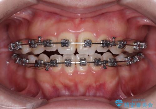 【モニター】舌突出癖で隙間が ワイヤー装置での抜歯矯正の治療中