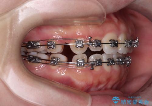 【モニター】舌突出癖で隙間が ワイヤー装置での抜歯矯正の治療中
