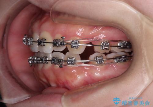 【モニター】舌突出癖で隙間が ワイヤー装置での抜歯矯正の治療中