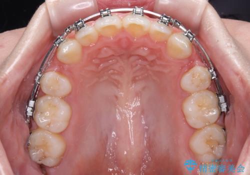 【モニター】舌突出癖で隙間が ワイヤー装置での抜歯矯正の治療中