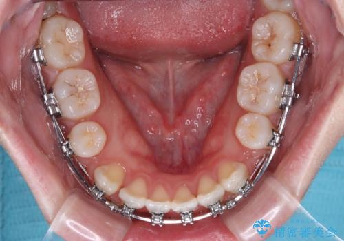 【モニター】舌突出癖で隙間が ワイヤー装置での抜歯矯正の治療中