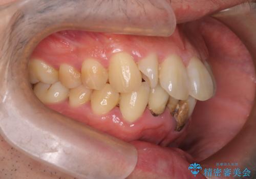 ハーフリンガル矯正による前歯部の叢生改善と口元の後退|上顎左右4番・下顎1番抜歯症例の治療前