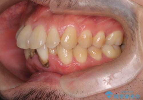 ハーフリンガル矯正による前歯部の叢生改善と口元の後退|上顎左右4番・下顎1番抜歯症例の治療前