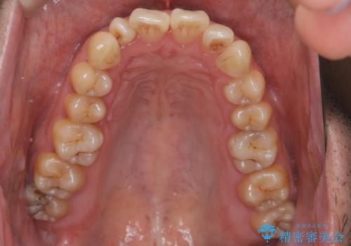 ハーフリンガル矯正による前歯部の叢生改善と口元の後退|上顎左右4番・下顎1番抜歯症例の治療前