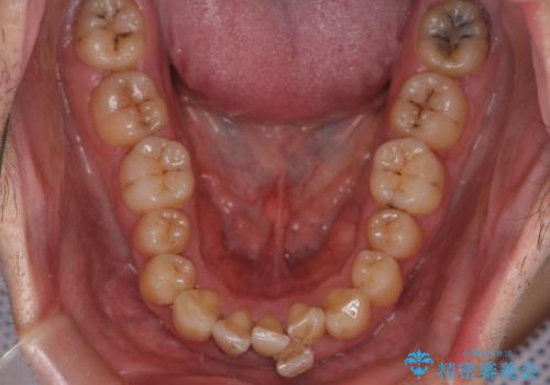 ハーフリンガル矯正による前歯部の叢生改善と口元の後退|上顎左右4番・下顎1番抜歯症例の治療前