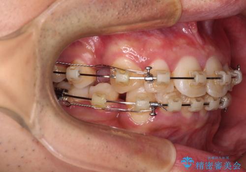 飛び出した前歯を治したい　ワイヤー装置での抜歯矯正の治療中