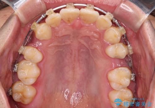 飛び出した前歯を治したい　ワイヤー装置での抜歯矯正の治療中