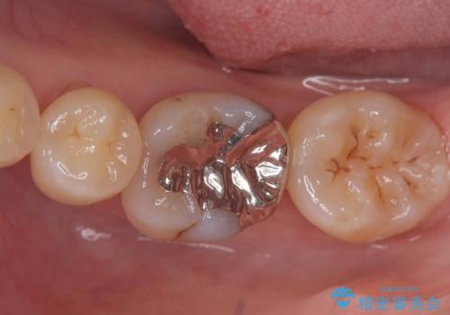 銀歯の下の虫歯|生活歯髄療法|VPT|神経を残すための治療|セラッミクインレーの症例 治療前