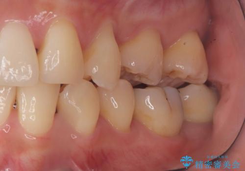 銀歯の下の虫歯|生活歯髄療法|VPT|神経を残すための治療|セラッミクインレーの治療前