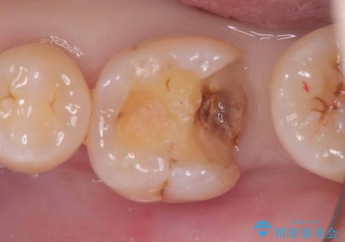 銀歯の下の虫歯|生活歯髄療法|VPT|神経を残すための治療|セラッミクインレーの治療中