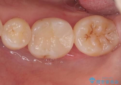 銀歯の下の虫歯|生活歯髄療法|VPT|神経を残すための治療|セラッミクインレーの症例 治療後