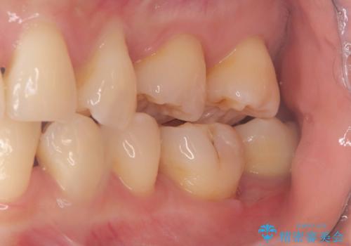 銀歯の下の虫歯|生活歯髄療法|VPT|神経を残すための治療|セラッミクインレーの治療後