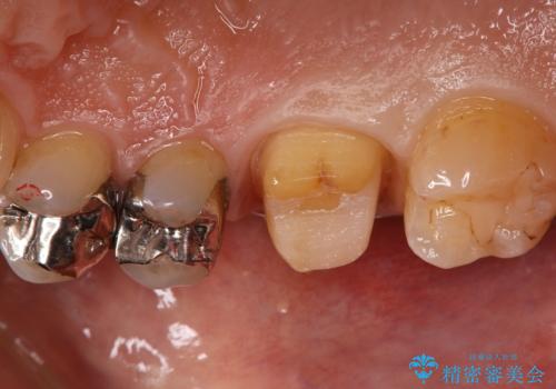 銀歯をセラミックに変えたいの治療中