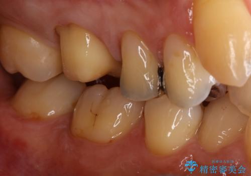 銀歯をセラミックに変えたいの治療中
