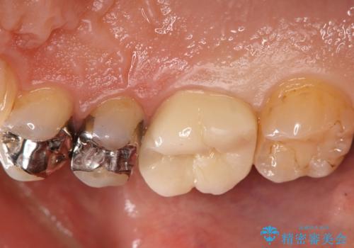 銀歯をセラミックに変えたいの治療後