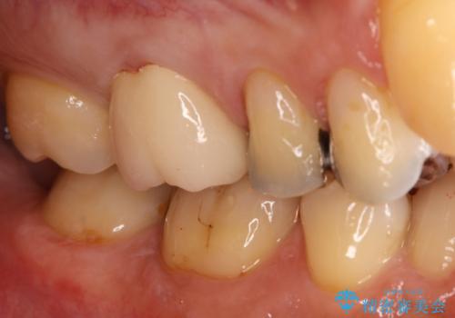 銀歯をセラミックに変えたいの症例 治療後