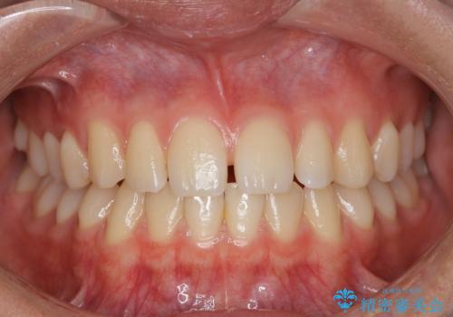 空隙歯列弓・正中離開(すきっ歯)の症例 治療前