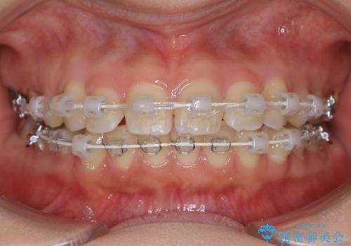 前歯のガタつきを改善 抜歯矯正後の後戻りの治療中