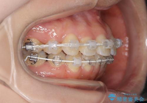前歯のガタつきを改善 抜歯矯正後の後戻りの治療中