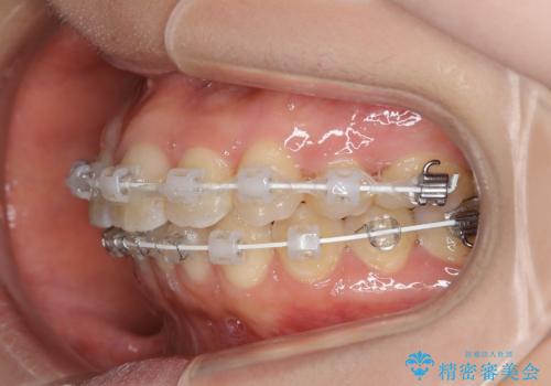 前歯のガタつきを改善 抜歯矯正後の後戻りの治療中