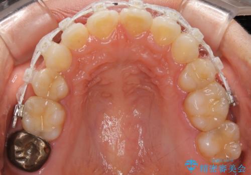 前歯のガタつきを改善 抜歯矯正後の後戻りの治療中